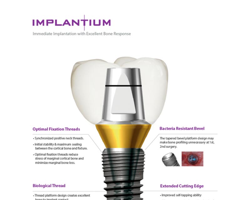 Read more about the article Sunt implanturile de la Dentium pentru mine? [Infografic]
