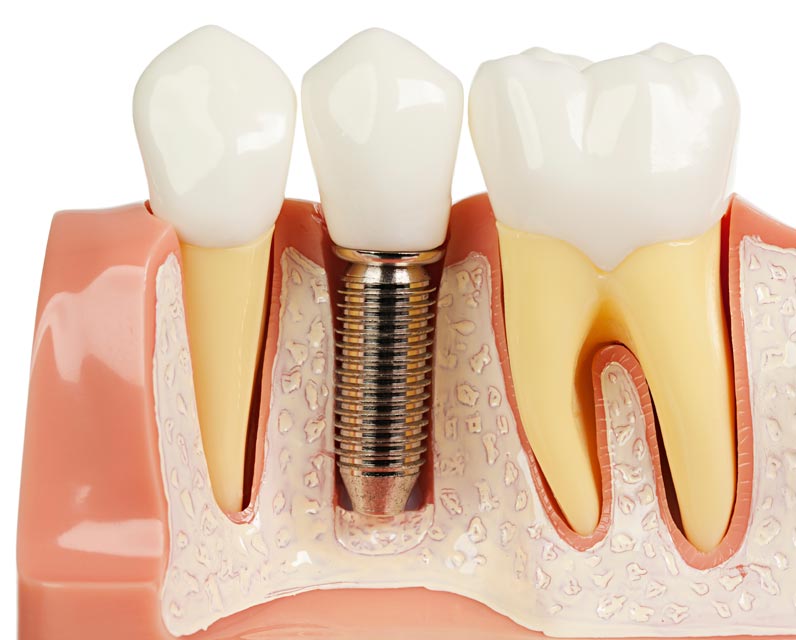 Read more about the article Care sunt potentialele riscuri, complicatii si probleme ale unui implant dentar?