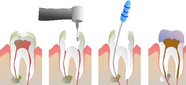 Citește mai multe despre articol Terapie si endodontia